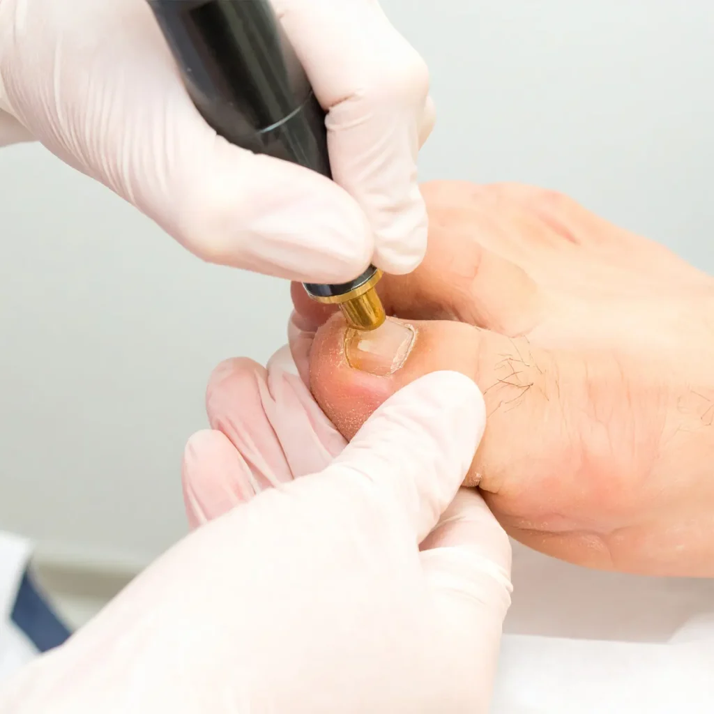 Nail Laser Treatment for Fungal Nail Infections